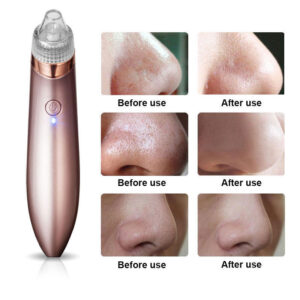 Clear Skin Revolution: Electric Blackhead Remover & Pore Minimizer